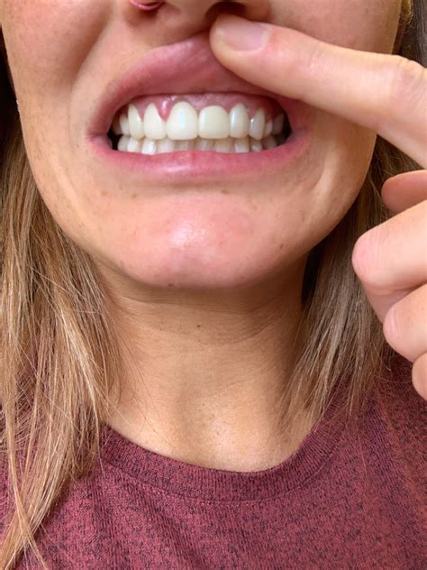 Severe pregnancy gingivitis despite good oral hygiene (brush 2x a day