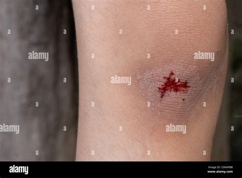 Scraped Knee Infection
