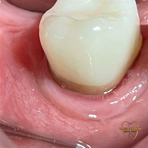 healing of the periapical lesion by 75% With disappearance of all symptoms, after one month of ...