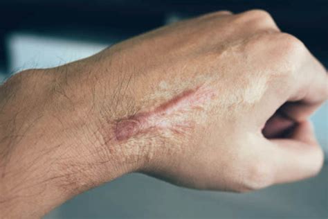 Keloid Scars | Brisbane Skin, Dermatologist Brisbane. Medical, surgical ...