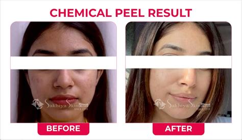 chemical peeling sakhiya skin clinic