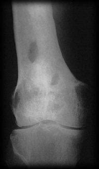 Osteomyelitis: Symptoms & Treatment | Musculoskeletal Issues articles ...