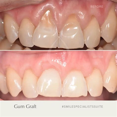 Gum Graft - Smile Specialists Suite