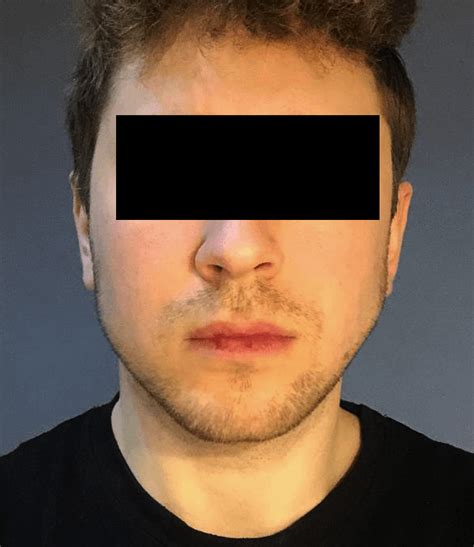 Weak Jawline procedures : r/PlasticSurgery