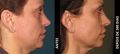 Ulthera Antes E Depois - Tratamento de lifting minimamente invasivo | Ultherapy