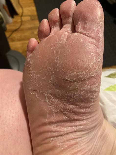 [Product Request] Extremely Dry Foot Skin : r/SkincareAddiction