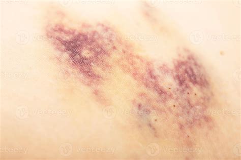 Bruises on the patient's body after injections, bruises under the skin