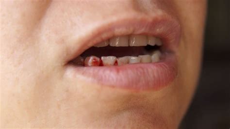 Sangue Saindo Da Boca - Gosto de sangue na boca: o que pode ser?