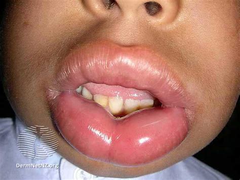Angioedema - RCEMLearning