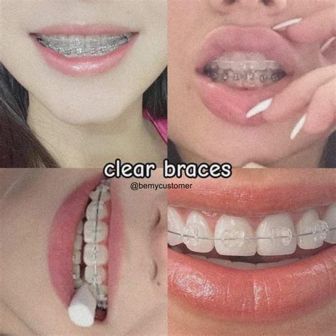 「Braces for me」おしゃれまとめの人気アイデア｜Pinterest｜callmeravyn【2024】