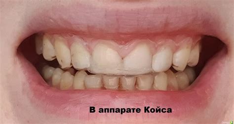 Глубокий прикус. - Ортодонтия - Стоматология для всех