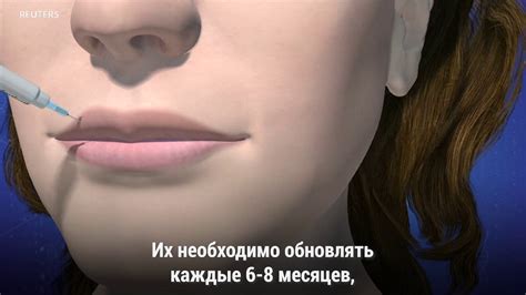 Как удаляют филлеры для увеличения губ? - YouTube