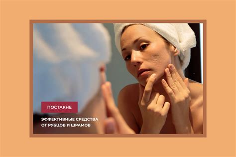 Рубцы постакне, как вылечить? | читать ☕