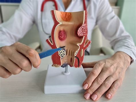 Qual O Medico Que Trata Hemorroida