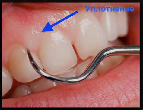 Рак десны: симптомы, причины, лечение | Взубе.ком