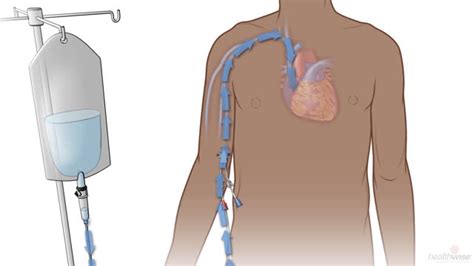 Central Venous Catheter: Changing the Dressing - MedicalRecords.com