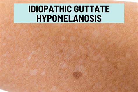 White Spots on Skin: 24 Causes, Pictures, Treatment