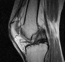 Knee - Lateral Meniscus Tear - AOA Orthopedic Specialists