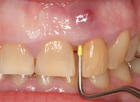 Tooth Abscess Drain