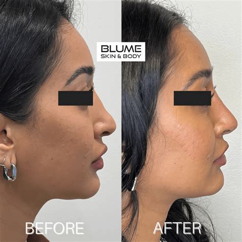 Dermal Fillers Before & After Photos Scottsdale, Arizona