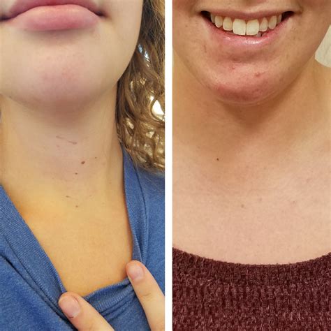 Hoarse Voice After Thyroidectomy 5