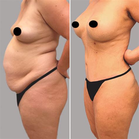 Tummy Tuck Before-and-After Photos: Real Patient Results