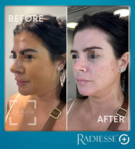 radiesse dr kara cosmetic clinic norwich norfolk