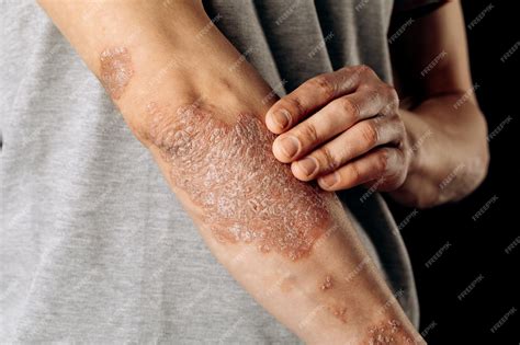 Premium Photo | Acute psoriasis on the elbows is an autoimmune ...