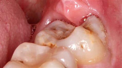 Wisdom Teeth Pain Remedies | River Dentistry