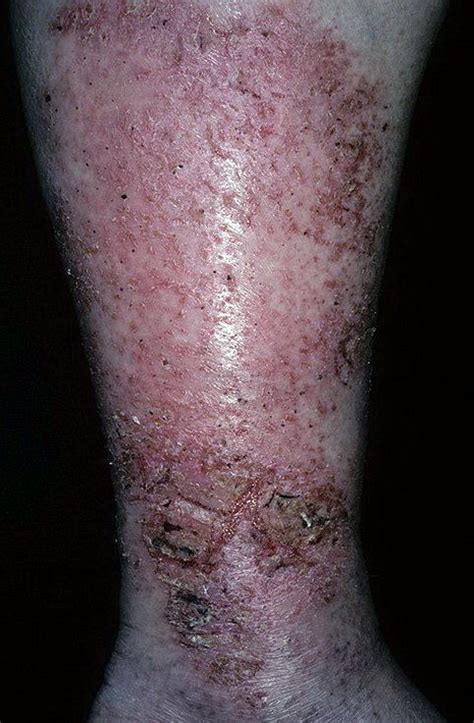 Варикозная экзема фото – 174 шт. / fotodiagnoz.com