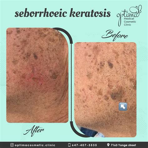 seborrheic keratosis treatment  care  optima medical cosmetic