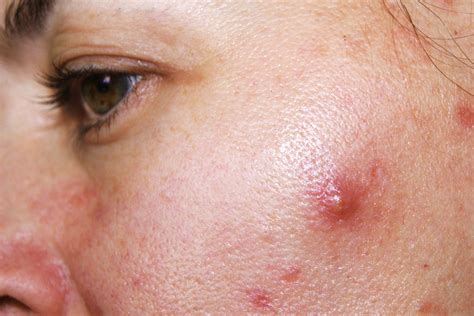 Akne Inversa Ursachen Therapieresistenter Hautkra