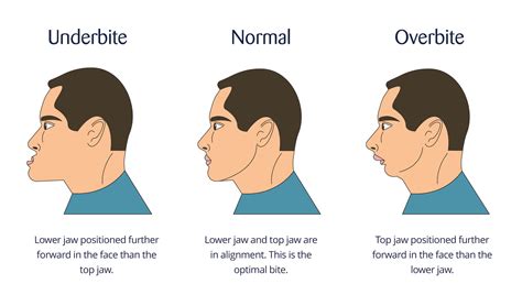 Overbite Teeth