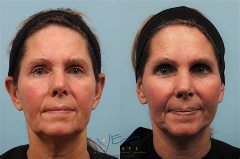 neck lift procedure steps  procedures  change  face shape
