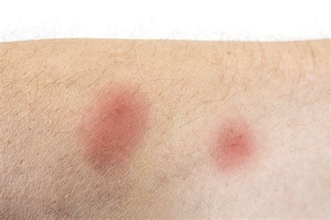 These Bug Bite Pictures Can Help You Identify A Mosquito Bite, Tick ...