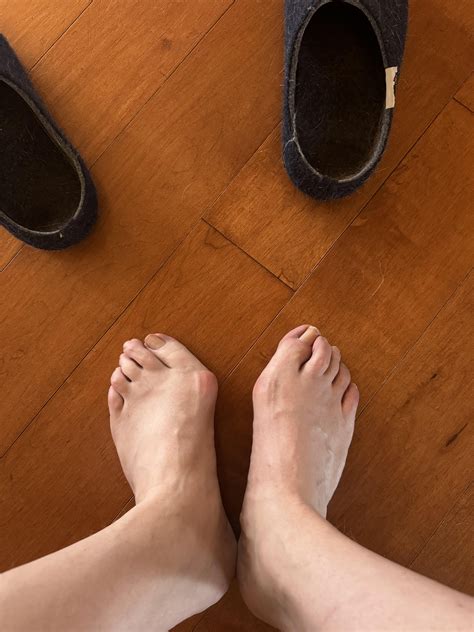 Is this the advanced bunion group? : r/bunions