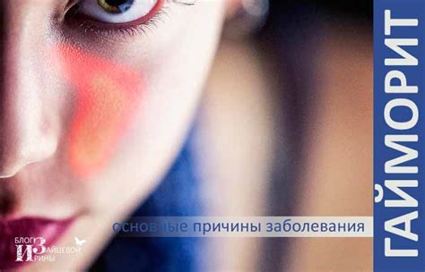 Симптомы и лечение гайморита у взрослых