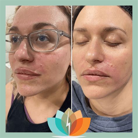 Platelet Rich Plasma Prp Injection - vrogue.co