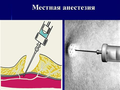 Местная анестезия - презентация онлайн