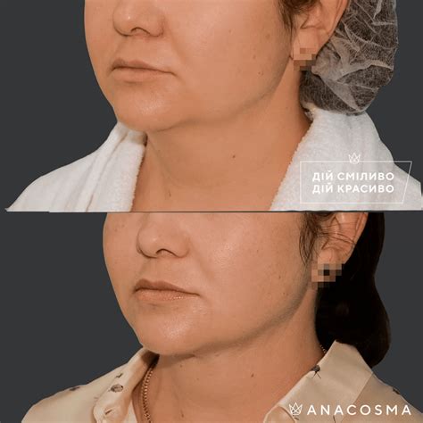 Липосакция лица: цены в Киеве ️ Клиника ANACOSMA