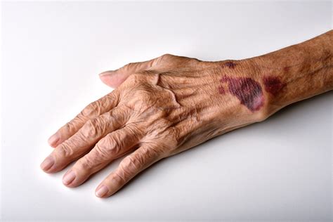 Degloving Injury - Stephens Law Firm, PLLC