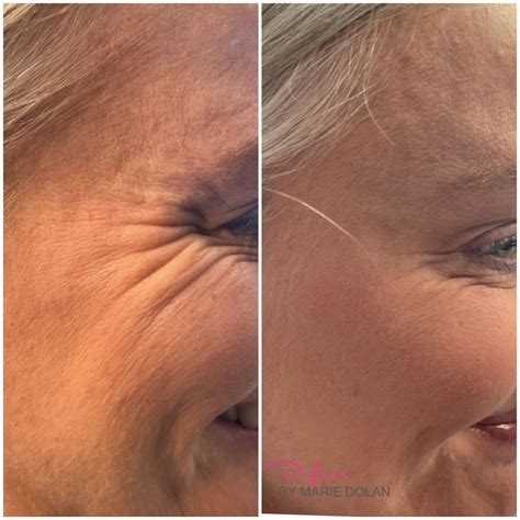 botox injections    artofit