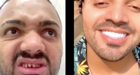 Tirulipa Antes E Depois - Tirulipa surpreende com antes e depois de "dentes repaginados" RedeTV!