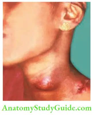 Surgical Site Infection Acute Infection Chronic Abscess And Sinus ...