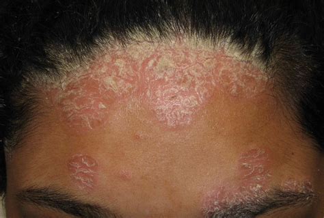 Bacterial Itchy Skin Rash at Callie Ellis blog
