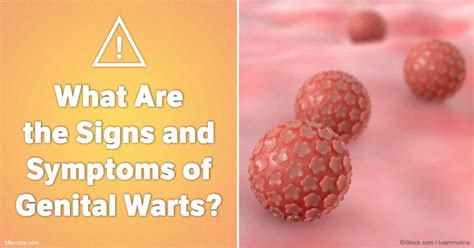 What Are the Signs and Symptoms of Genital Warts?