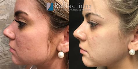 RF Microneedling for Acne Scars Results Super-Charged! Before & After ...