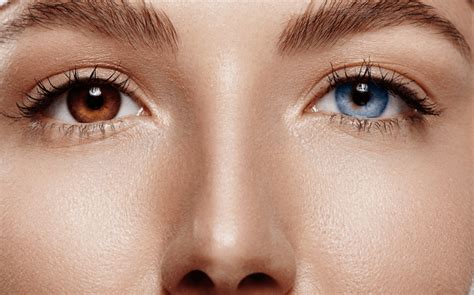 Different colored eyes? Heterochromia