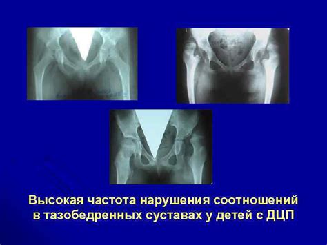 Реконструктивные операции на тазобедренном суставе в системе лечения