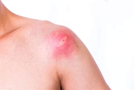 7 types of bug bites Canadians can expect this summer - National ...
